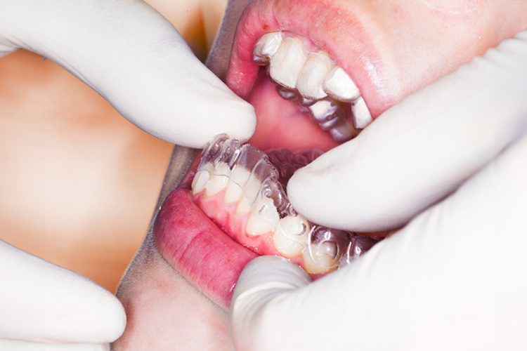 Patient wearing orthodontic retainers after orthodontic treatment to maintain a straight smile